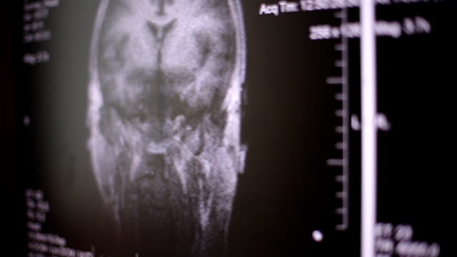 Blick-auf-Computer-Bildschirm-beim-Patienten-bewegt-sich-in-MRT-Gerät-Arzt,-analysiert-der-Arzt-die-Ergebnisse-der-Kernspintomographie-auf-seinem-Laptop.-4k,-Hintergrund-unscharf