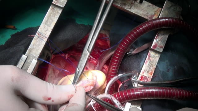 Heart-with-surgical-thread-during-operation-on-live-organ-of-patient-in-clinic.