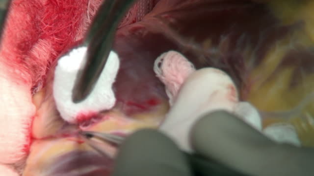 Macro-única-cirugía-corazón-video-cerca-en-clínica.