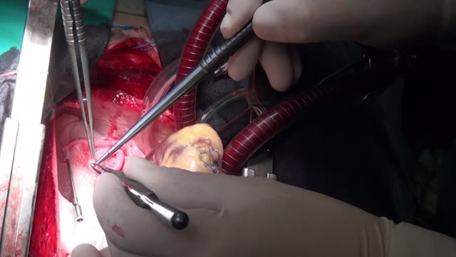 Heart-surgery-unique-macro-video-close-up-in-clinic.