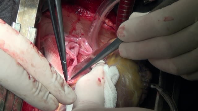 Macro-única-cirugía-corazón-video-cerca-en-clínica.