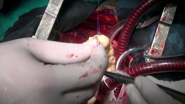Heart-with-atraumatic-suture-material-surgical-thread-during-operation.