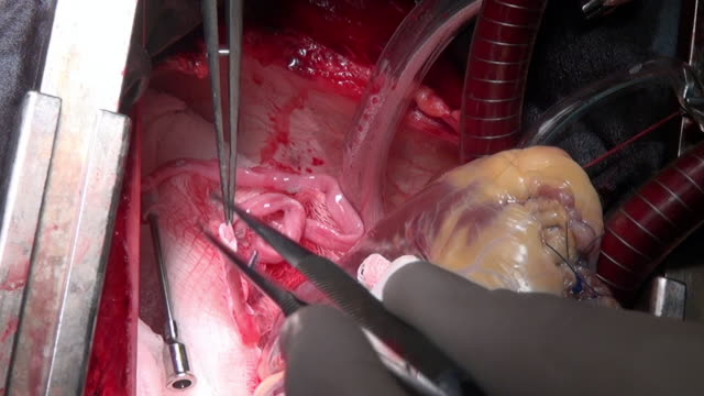 Herz-Chirurgie-einzigartige-Makro-video-hautnah-in-Klinik.