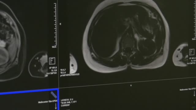 Gehirn-Tomographie-auf-MRT-Untersuchung.