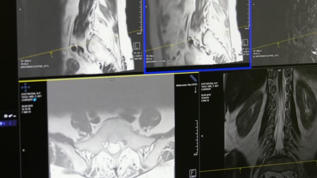 Rückenmark-und-Wirbelsäule-Tomographie-auf-MRT-Untersuchung.