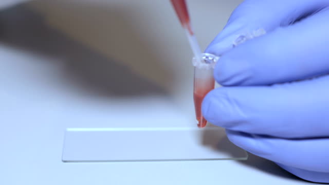 Laborantin-holding-Pipette-und-testen-Blutproben-auf-Krankenstation-für-Bluttransfusion,-Hände-schließen-sich.-Nahaufnahme-des-Arztes-hält-Reagenzglas-des-Blutes.-AIDS-/-HIV-Krankenhaus-Blut-Test.