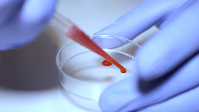 Técnico-de-laboratorio-manteniendo-la-pipeta-y-muestras-de-sangre-en-sala-del-hospital-para-transfusión-de-sangre,-las-manos-cerca-para-arriba.-Closeup-de-médico-sosteniendo-el-tubo-de-ensayo-de-la-sangre.-SIDA-/-VIH-Hospital-prueba-de-sangre.