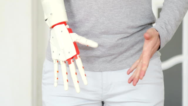 El-paciente-está-probando-su-nueva-mano-protésica-robótica-la-primera-vez