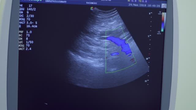 Screen-of-ultrasound-equipment