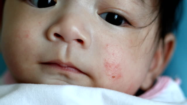 bebé-salud-alérgico-irrita-dermatitis-en-la-piel-de-la-cara