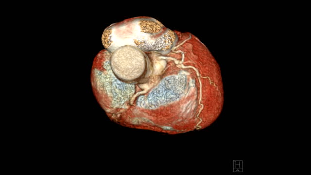 CTA-Coronary-artery-3D-rendering-image-turn-around-on-the-screen-for-diagnosis-of-vessel-coronary-artery-stenosis-.