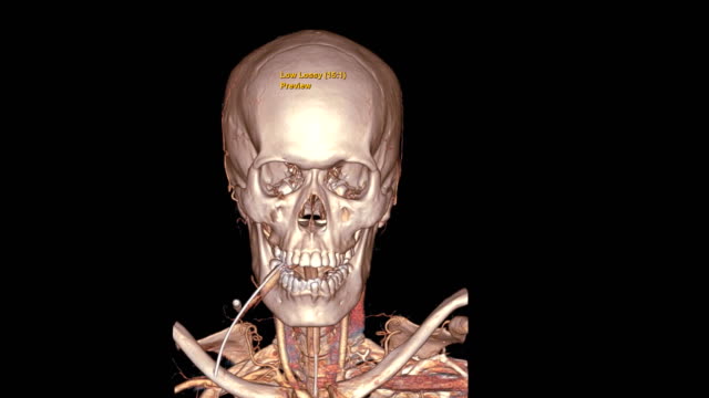 CTA-Gehirn-oder-Computertomographie-Angiographie-des-Gehirns-3D-Rendering-Bild-mit-Endotrachealrohr.