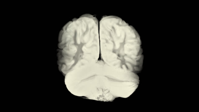 Sección-vertical-a-través-de-los-hemisferios-cerebrales-con-alfa-mate