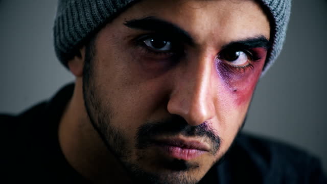 Young-latin-man-with-wounded-black-eye-staring-the-camera