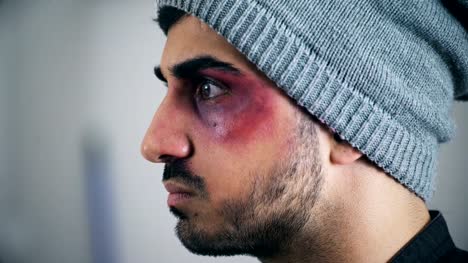 Profil-von-einem-jungen-Mann-im-Gesicht-verletzt,-Nahaufnahme