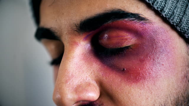 junger-Mann-verletzt-in-sein-Gesicht,-Nahaufnahme