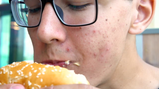 A-young-man-with-acne-on-his-face-eats-hamburger.