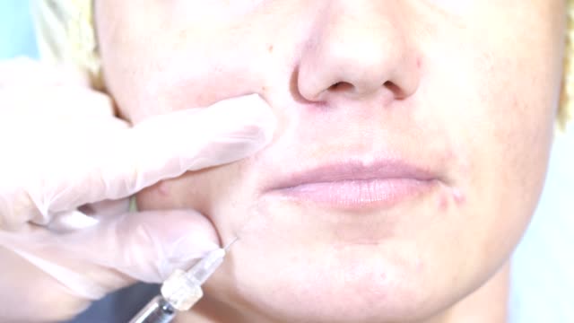 Frau-immer-Injektion-Gesicht-empfangen-Gesichtsbehandlung-Klinik-Füllstoffe-Spritze-Injektor-Verfahren-der-plastischen-Chirurgie