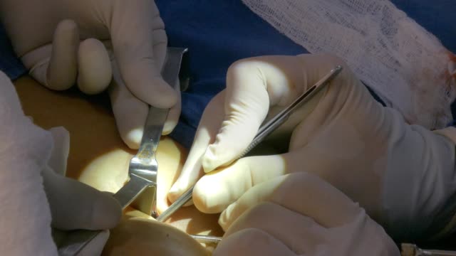 Surgeon-doing-surgical-suture-or-stitches-on-chest-after-removing-cartilage-for-nasal-septum-deviation-and-rhinoplasty-surgery-on-female-patient.-Female-patient-under-general-anesthesia.