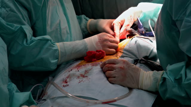Médicos-del-operador-hacer-cirugía-a-corazón-abierto-Closeup-de-arteria-coronaria-bypass-cirugía-del-injerto.