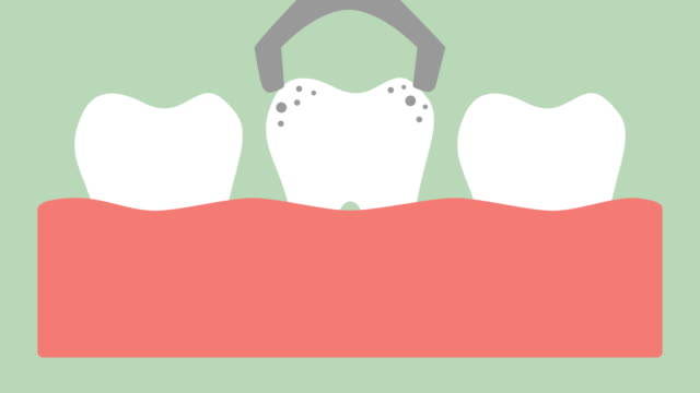 Zahnextraktion-durch-zahnärztliche-Instrumente,-Entfernung-Verfall-Zahn