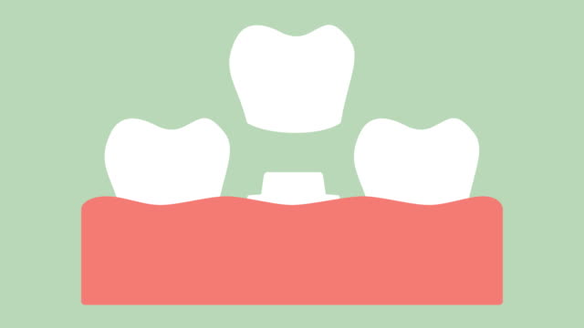 dental-crown,-installation-process-and-change-of-teeth
