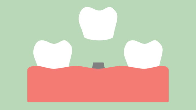 Zahnimplantat,-Installation-und-Zahnwechsel